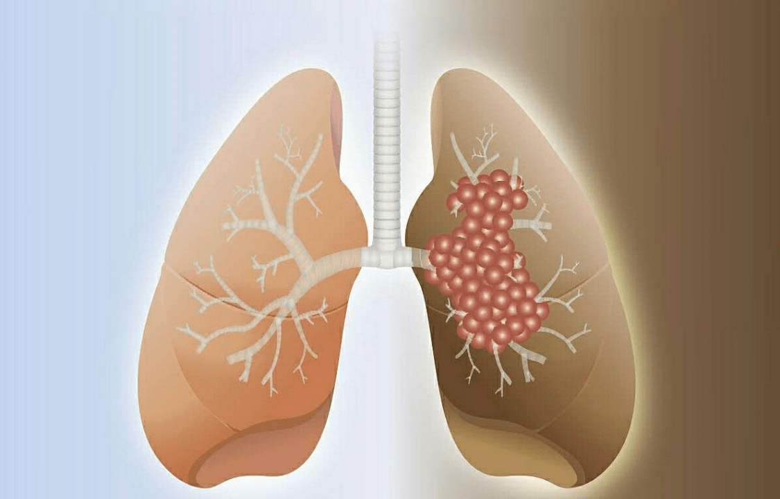 原创早期肺癌发生后皮肤会有什么表现