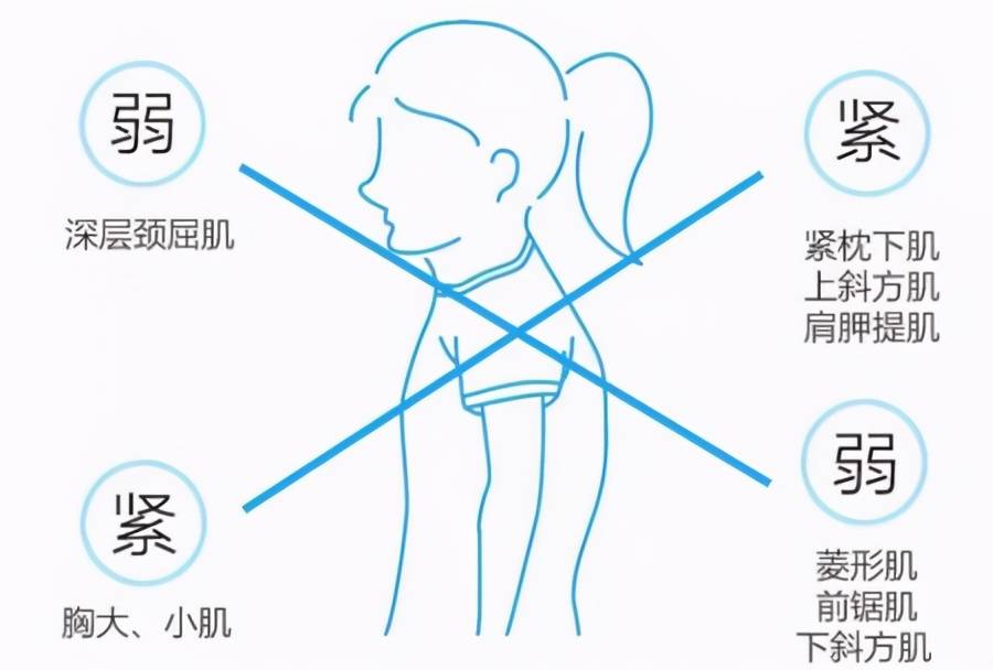 肩膀疼痛其实就是斜方肌疼痛.