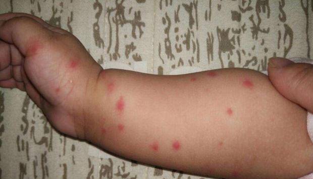 宝宝总招蚊子叮咬?这些适合宝宝的防蚊虫方法,父母赶紧学起来_孩子