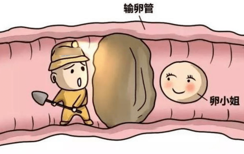 有这5种情况的女性,请尽快检查输卵管