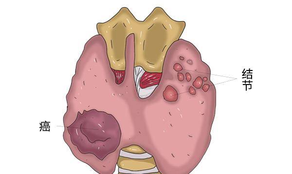 什么是恶性结节和良性结节 7578746727194432a61b38053904d278.jpeg