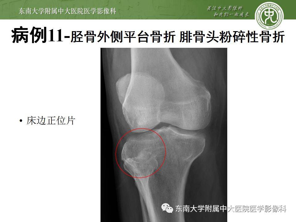 急诊必看 22个四肢骨关节外伤x线易漏诊病例 平台