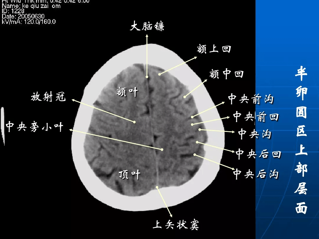 影像总结头颅ct基本知识与常见病变