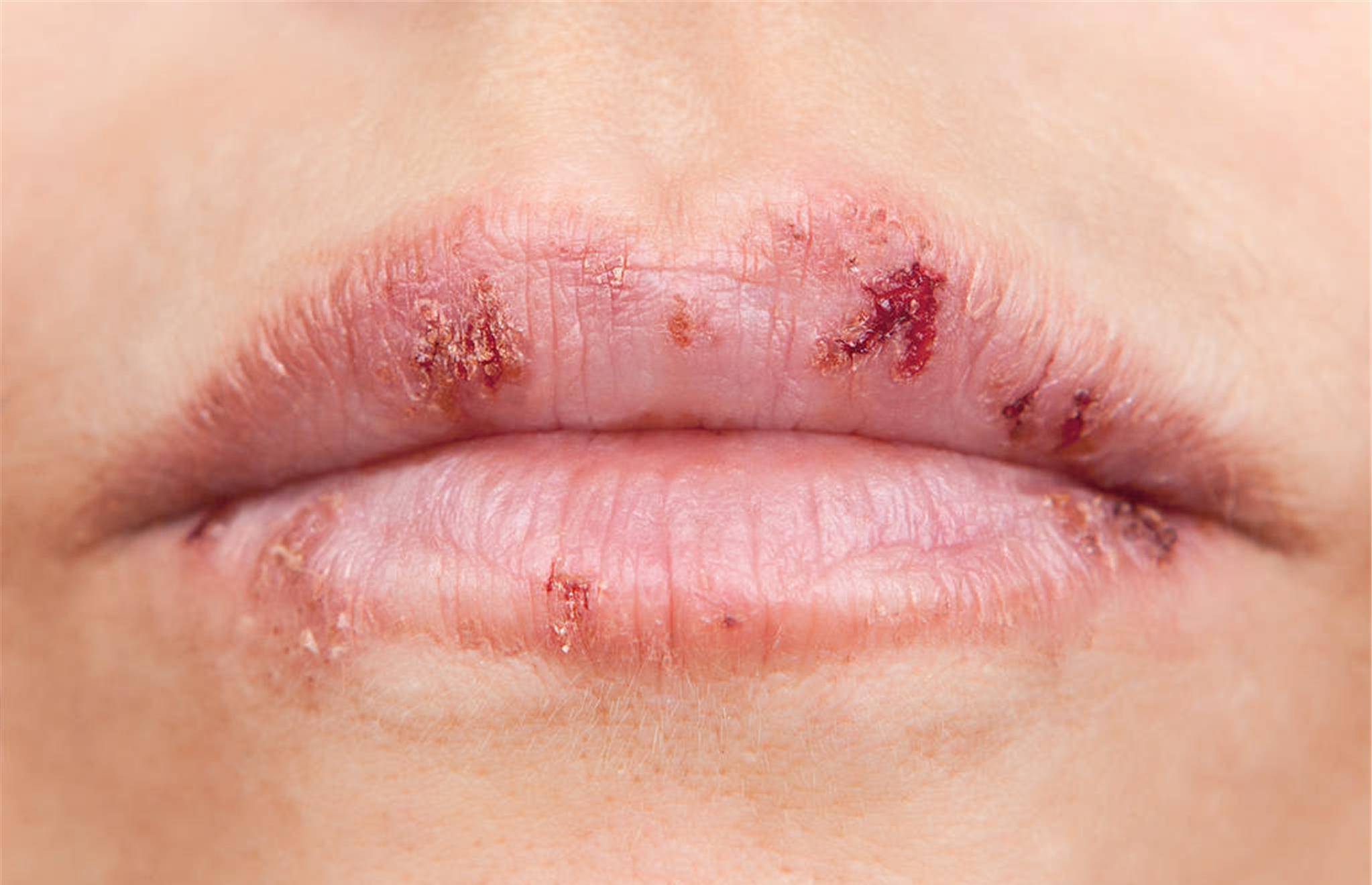 冬季如何预防嘴唇干裂？