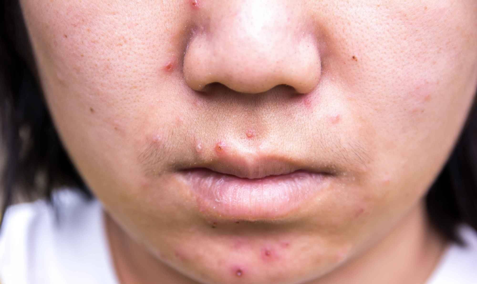 疯狂长痘的5个坏习惯!