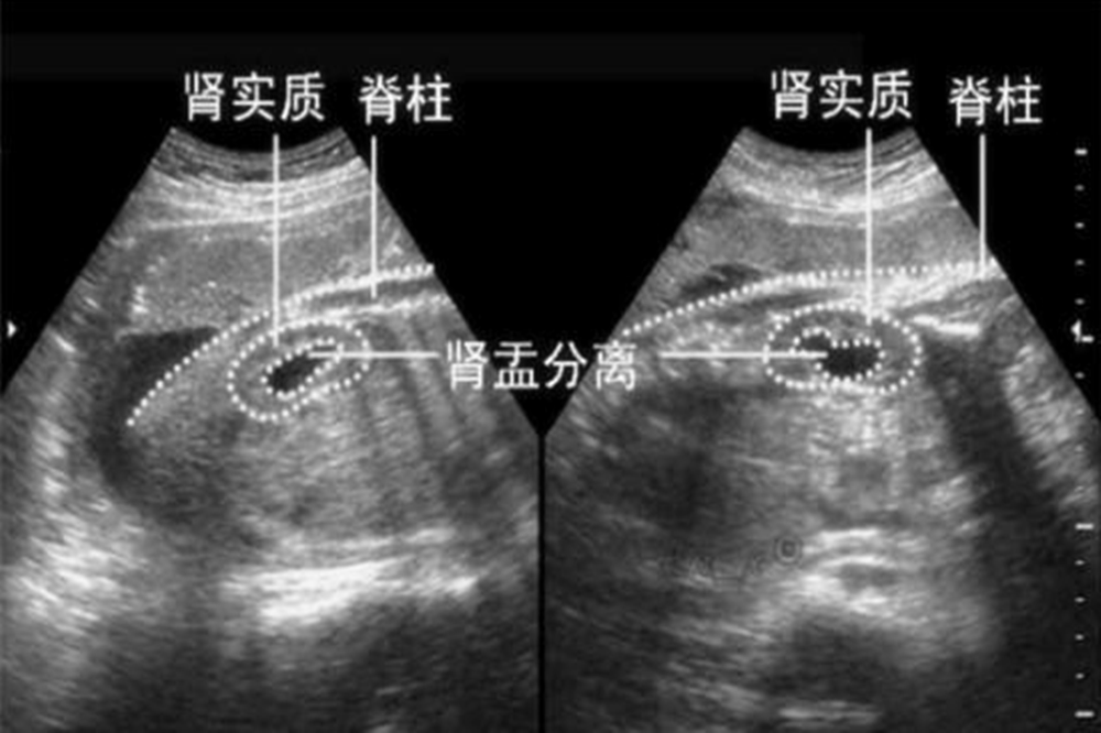 原創b超單上4個字輕鬆驗男女腎盂分離能暗示胎兒性別嗎