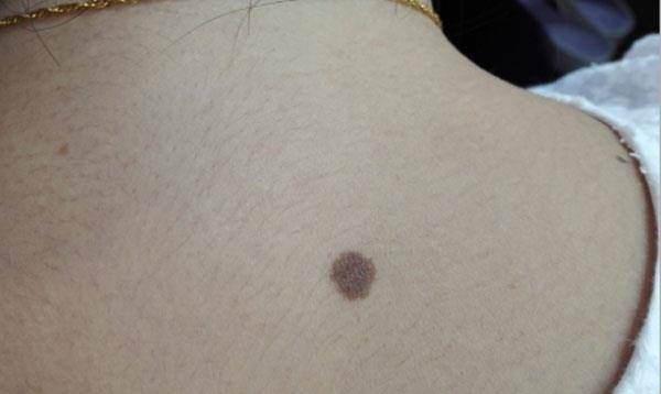 什么是黑色素瘤病 50cd097e888f4f2a918a059bd47c7678.jpeg