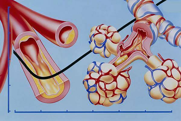 如何预防肺气肿的发生 6d2b09e517494f249f88a4f33295748a.jpeg