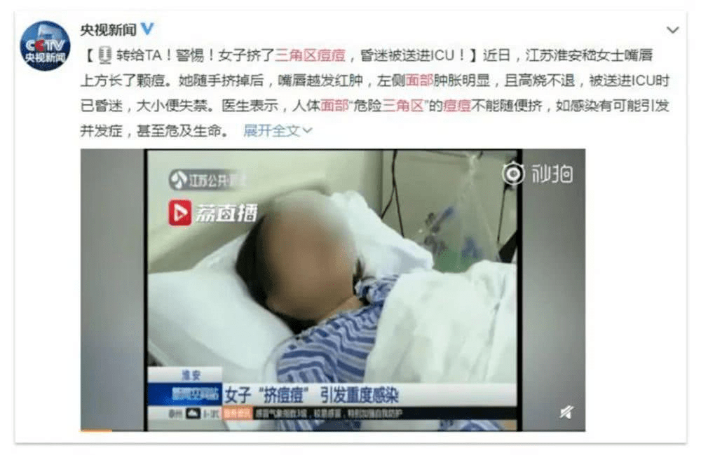 如何正确挤脓包 6aa2bf5aa1a04b38b7f999f06c19f7ae.png