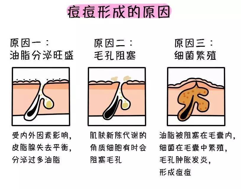 炎症阿澈达人：痘痘不及时护理？小心秒变痘痘肌！