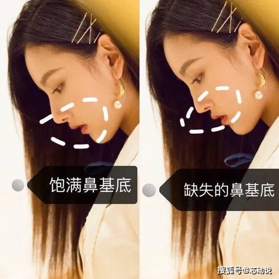 为什么越来越多人做鼻基底鼻基底是什么