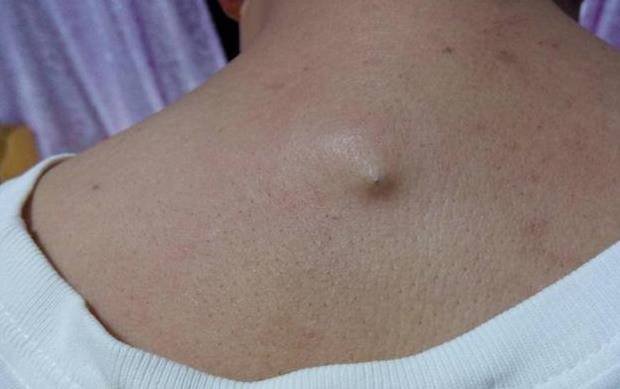 以下现象都是螨虫的痕迹螨虫喜欢油脂,皮脂屑,我们床成为了它们固定