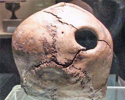 原创华佗真能给曹操开颅治病5300年前的古人类头骨发现上面有个洞