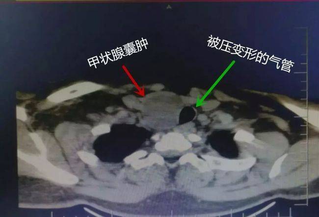 甲状腺峡部囊肿图片