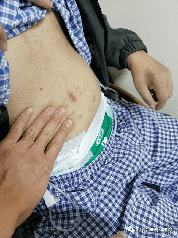 中医科治疗特殊腹胀患者一例