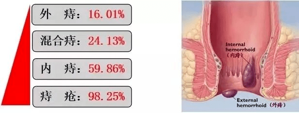 有u201c痔u201d之士的福音u2014u2014内痔的内镜下治疗_症状