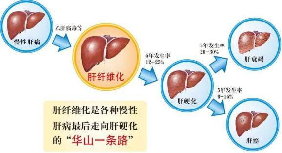 第二,脂肪肝患者,肝細胞會變性,壞死,警惕發展成肝纖維化,肝硬化.