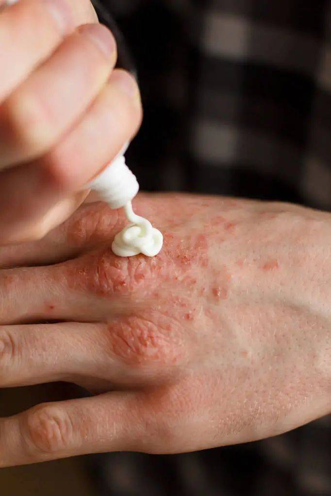 知识科普|为什么会得湿疹，治疗湿疹怎样去根？