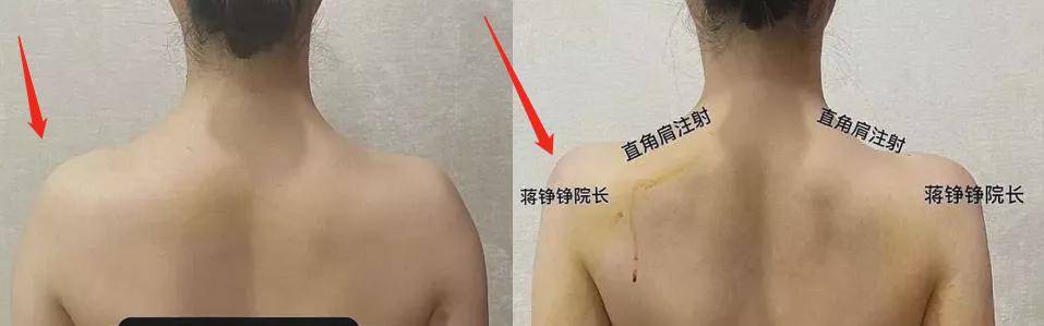 鞠婧祎|鞠婧祎对自己的肩膀到底做了什么？