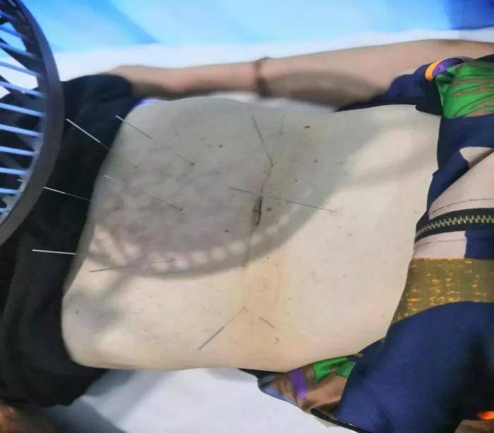 局部|丨康复馆丨针灸治疗妇人腹痛案