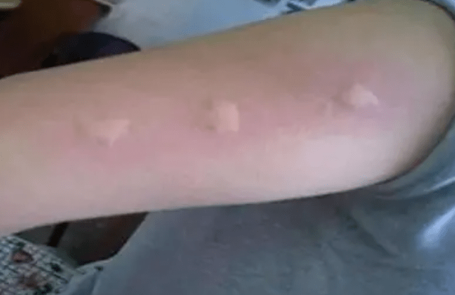 夏天被蚊子叮,为啥有人出现大包,有人出现小红点,有啥不一样?