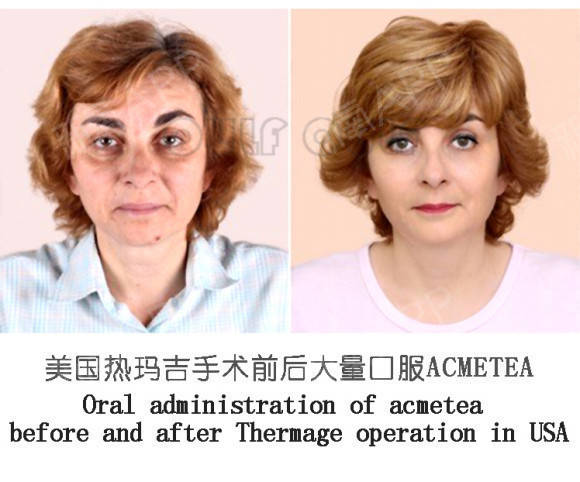 玛吉|热玛吉原理及作用原来是这样，怪不得被称为去皱神器