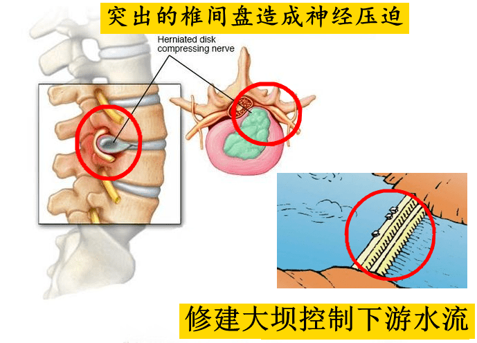 科普|脊柱科普丨腿痛？可能是腰出现了问题！
