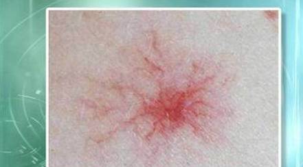 肝脏|肝脏发生肝硬化,6个症状会“提醒”你,越早去医院越好