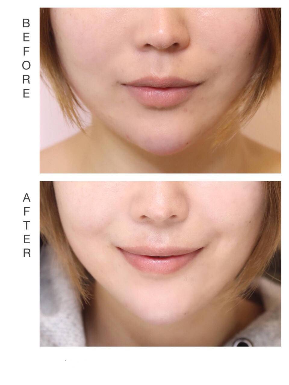 晒斑|这点没做好，脸上的斑肯定找上门