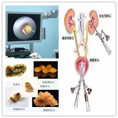 肾脏|得了肾结石，去年打了一次，现在还能再打？医生给您一次性说清楚