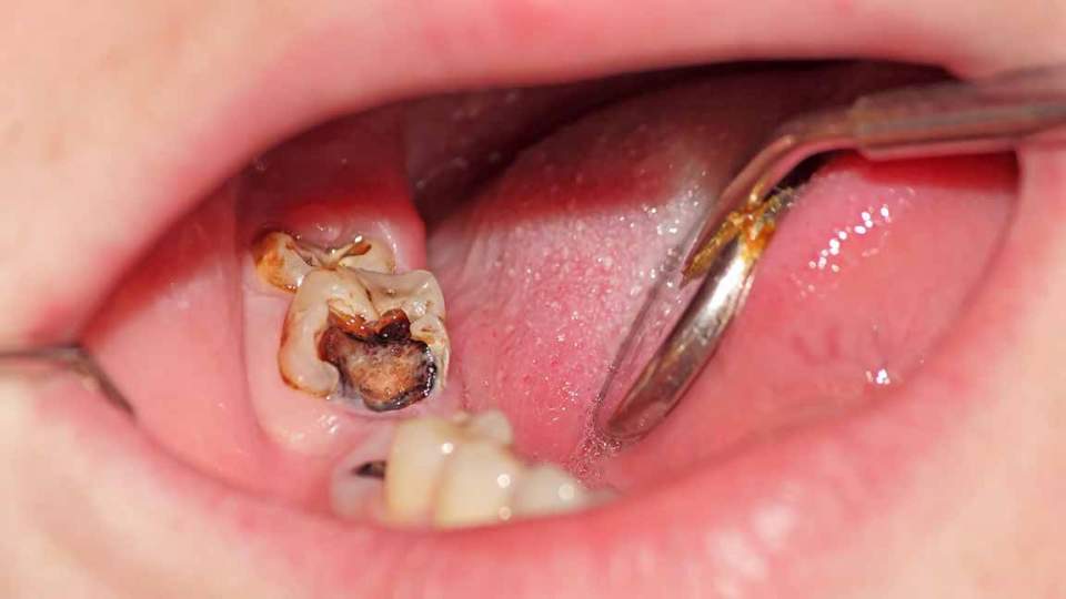 进入备孕期后就应把改补的蛀牙,该拔的智齿都处理掉.