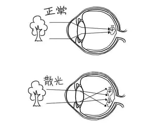 孩子屈光不正,早发现早治疗_散光