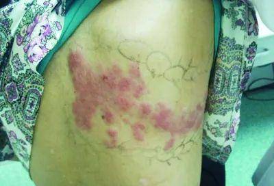 疱疹怎么引起的神经痛 468cf689e564441eb03e071c68e426f1.jpeg