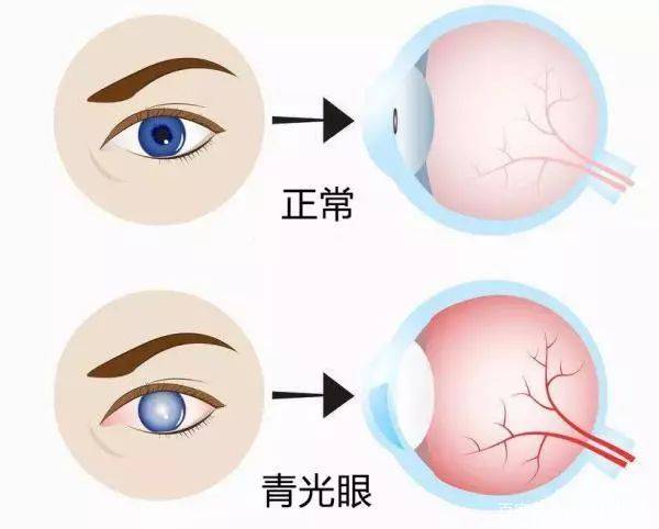 是什么原因引起白内障 a8c23b8a61734c8498dc535f29d58a09.jpeg