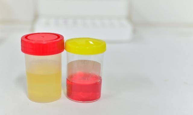 状况|肝不好的人，上厕所可能有这三种情况，若没有肝脏还不错