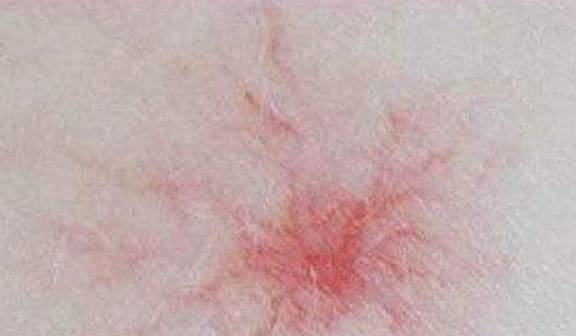 肝脏|肝好的人，可能没这2种“痣”，若你也如此，真有福气