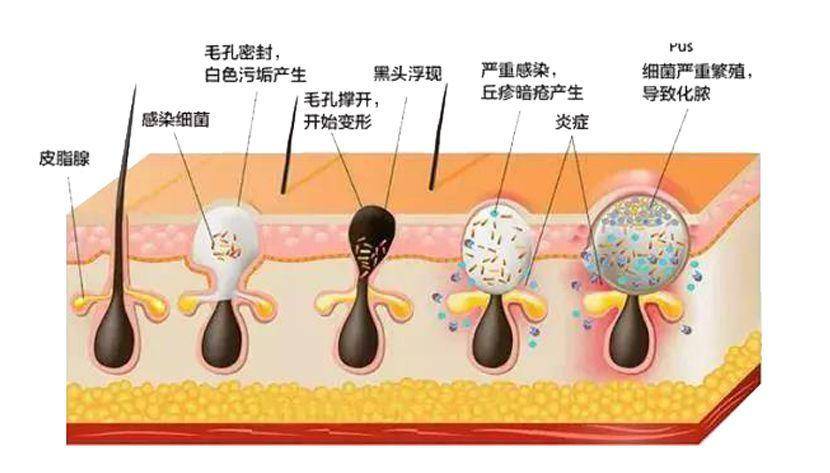 品牌|被低估的护肤神器！越敷越美的秘诀原来是佳宝莱毛孔净透冰川泥面膜