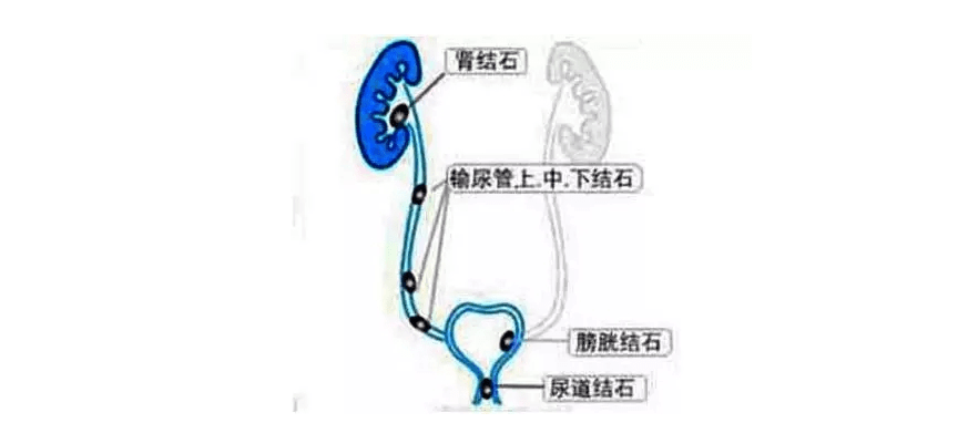 一名8歲的患兒確診了腎臟和輸尿管結石錯失最佳治療時機