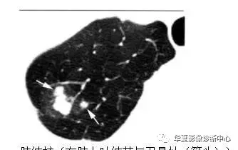 ct報告單提示有肺結節但卻弄不清良惡性今天手把手教你看懂