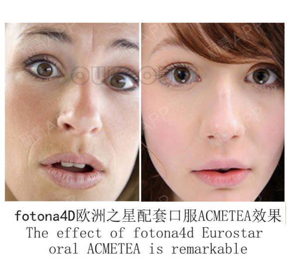 什么|fotona 欧洲之星到底是什么？咋朋友圈里都在晒
