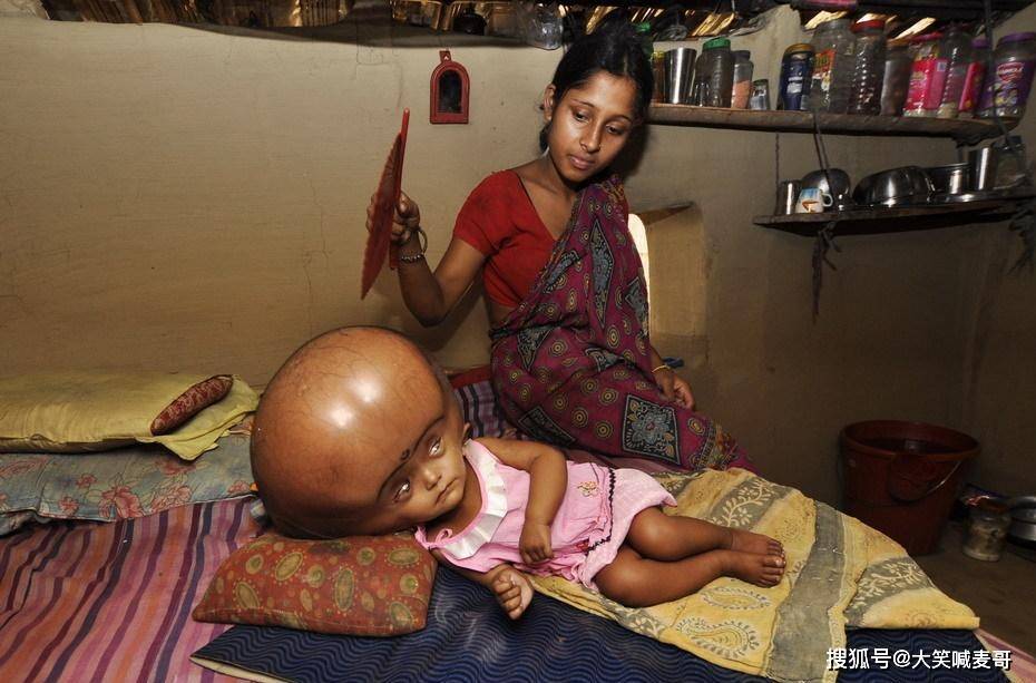 原创印度女孩脑积水94厘米的头围像外星人五岁半还无法说话