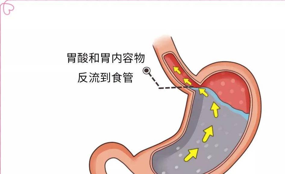 治疗|胃食管反流,奥美拉唑需要这样用,长期服用这样才能避免副作用!