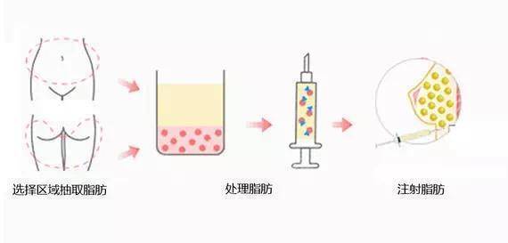 永久|脂肪填充是永久的吗?说可以永久保持是骗人的吗?隔壁阿姨越老越有气质