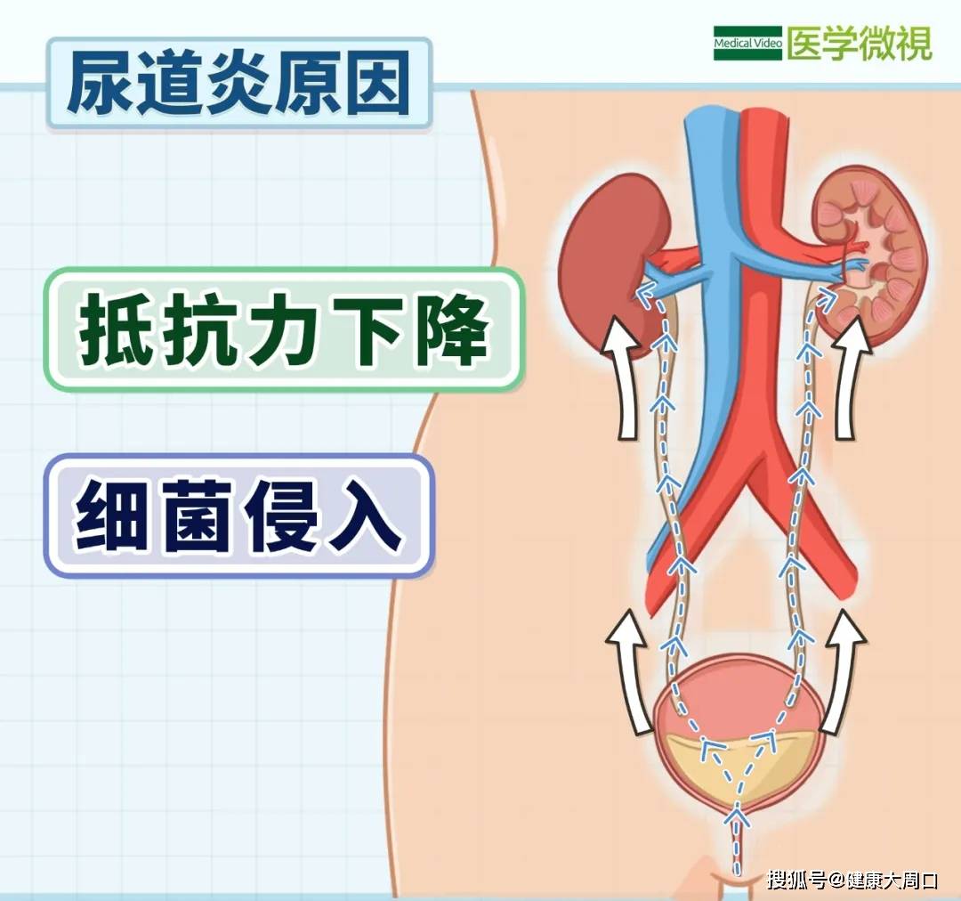 下尿路感染