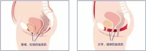 琳达|大连美琳达妇产医院：女性产后盆底肌修复有多重要 也许你还不清楚