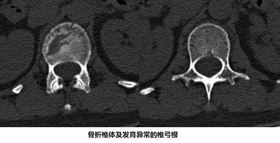 辅助|西安市中心医院老年骨科中心成功完成医院首例导航机器人辅助下脊柱手术