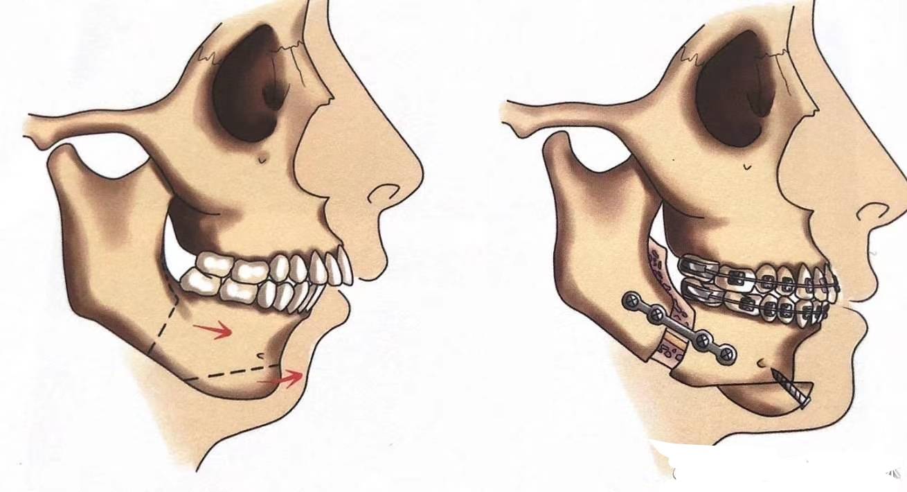 牙颌面畸形是什么原因导致的,有什么手shu方式?