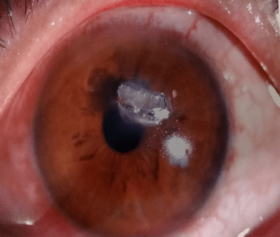 患者|【爱眼护眼77】眼睛里进了异物怎么办