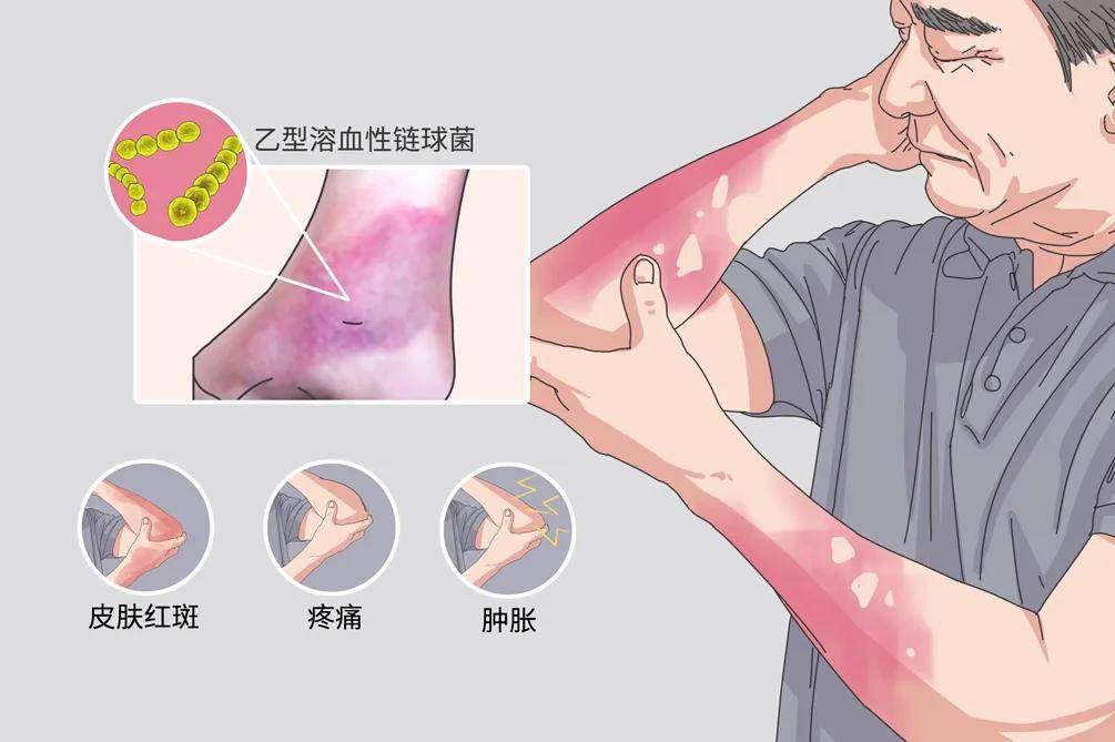 案例分享 治疗丹毒