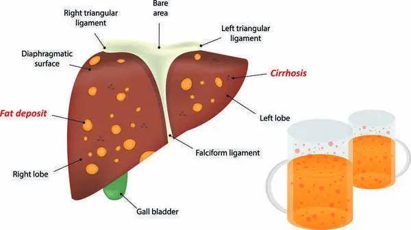 症状|从乙肝到肝癌，患者该如何规避肝癌风险？
